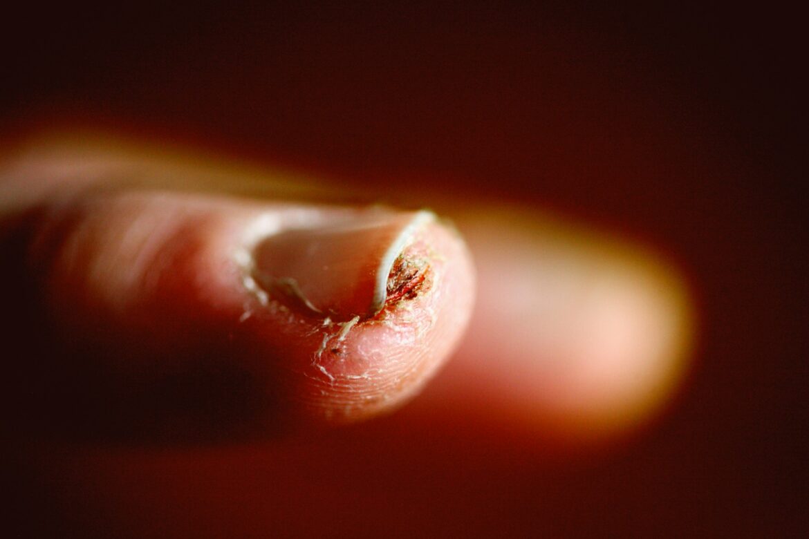 infiltration-ongle